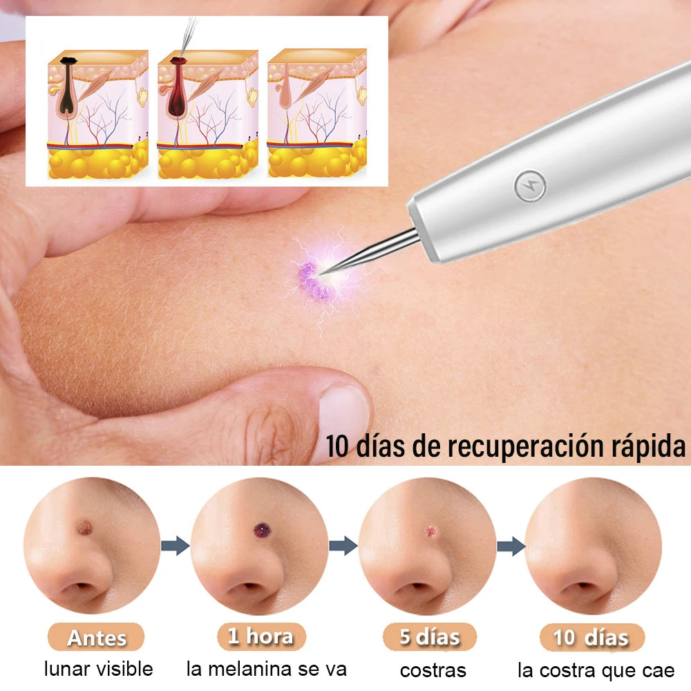 Pluma Láser de Plasma